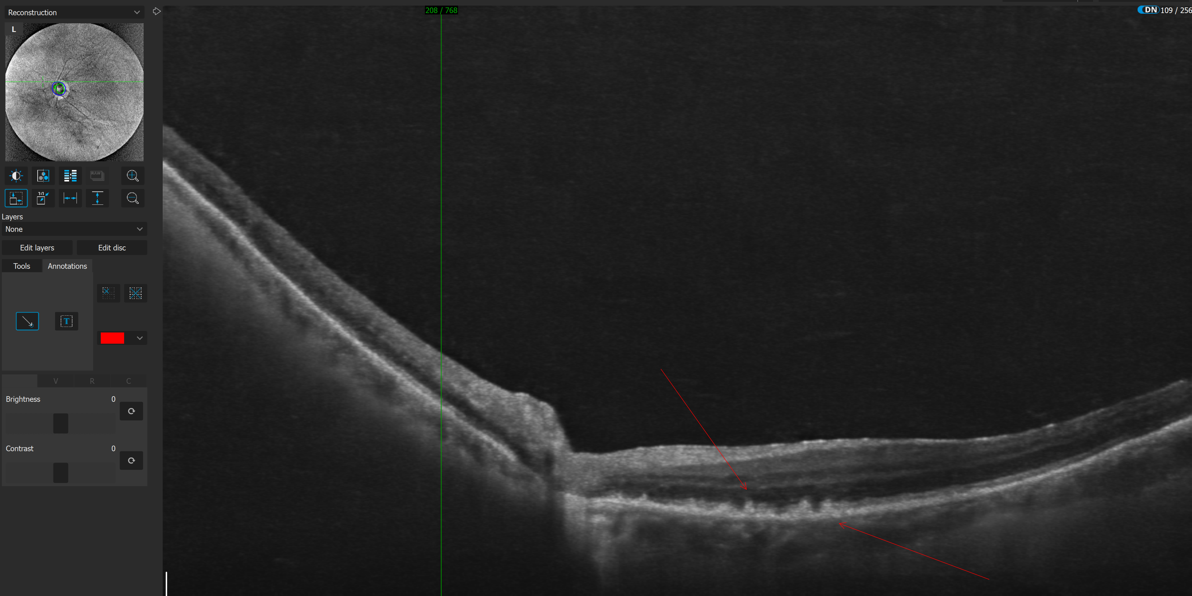 AMD makuladegenerasjon undersøkelse – SmartLook Optikk Sørumsand